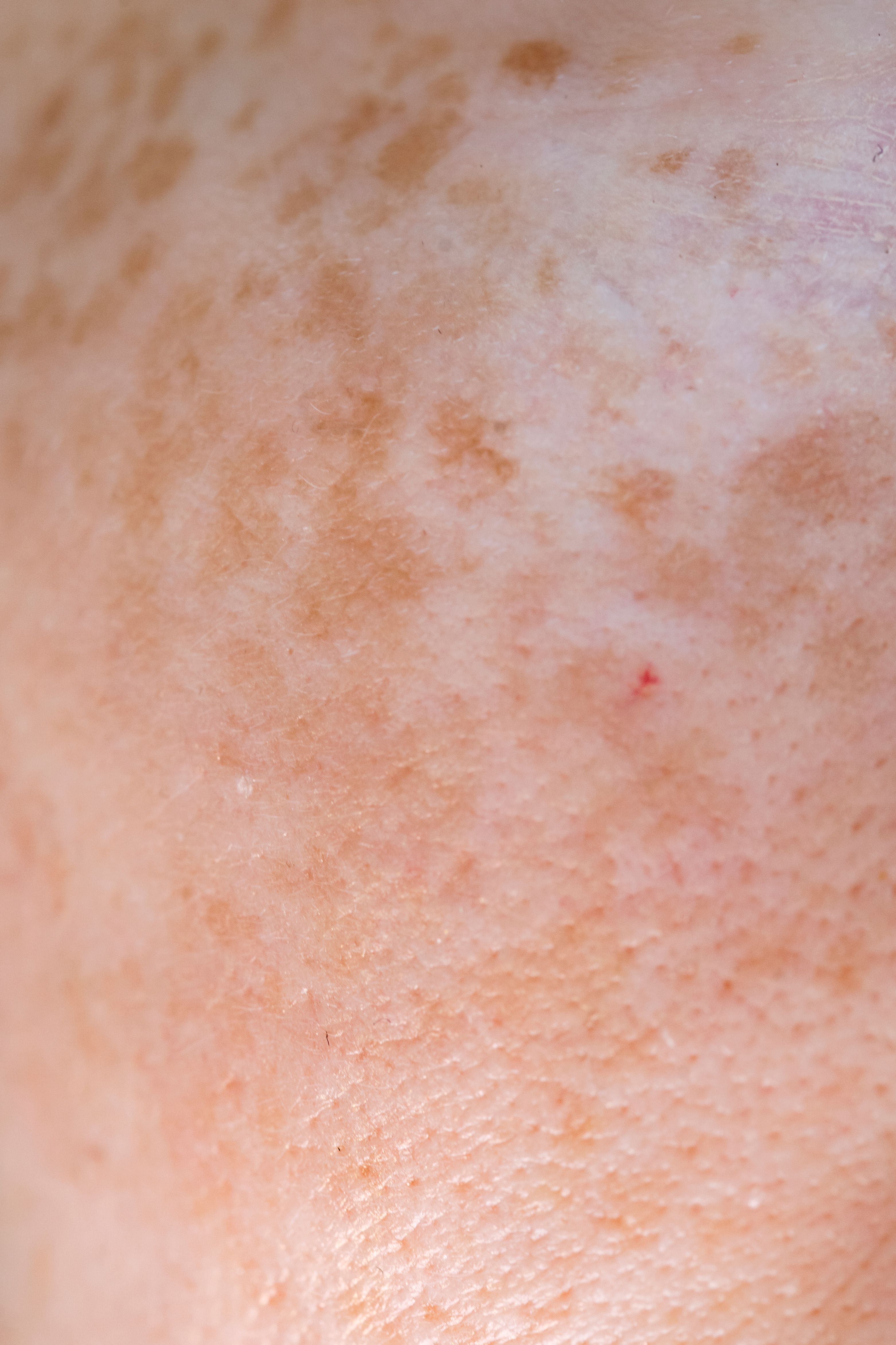 Best Pigmentation Treatments in Korea: Pico, IPL & Laser Toning - Wellisia