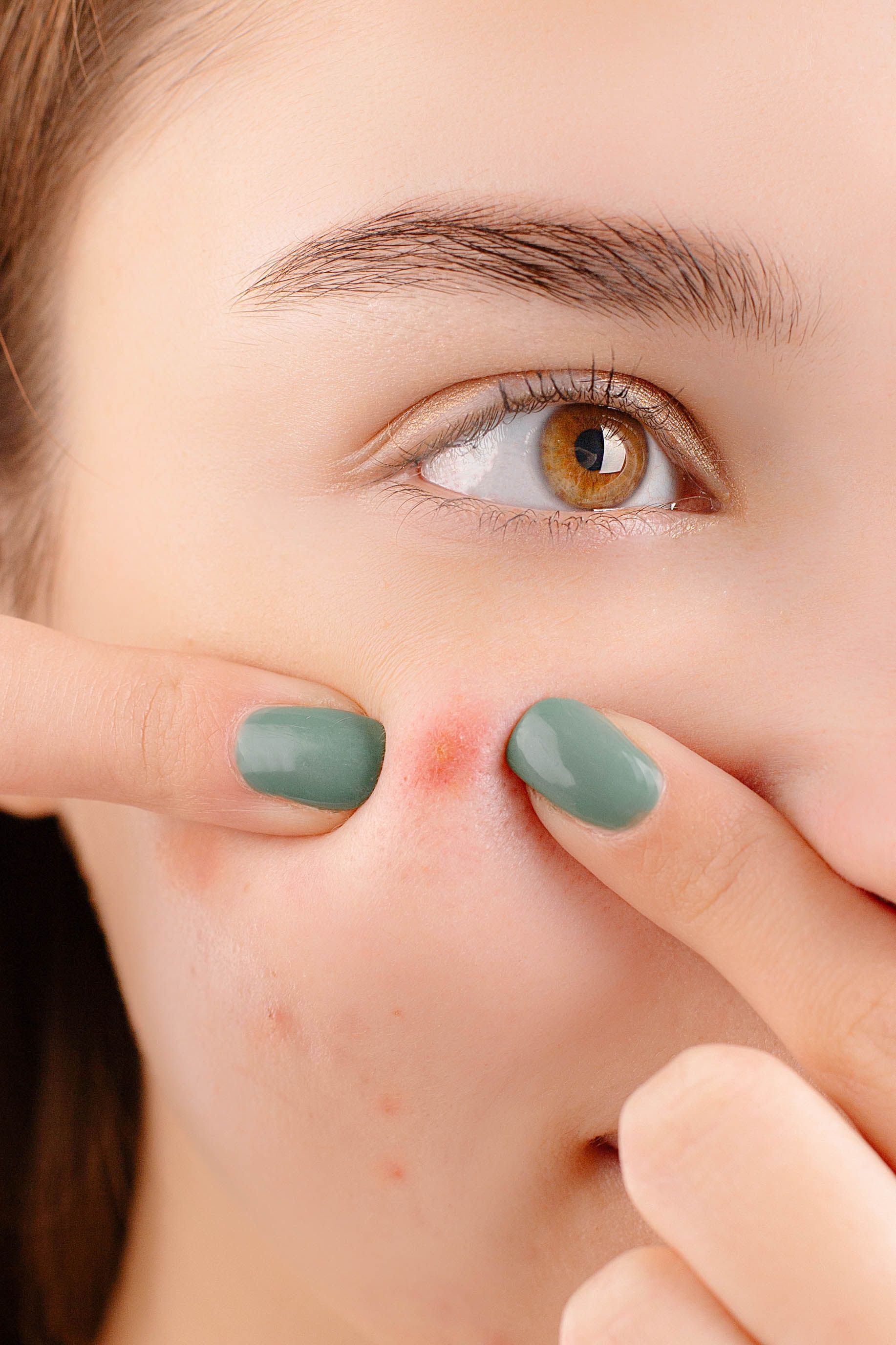 Best Acne Scar Treatments in Korea: Potenza, Pico, Juvelook & More - Wellisia