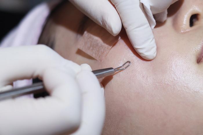 Acne Calming Care — 1 Session