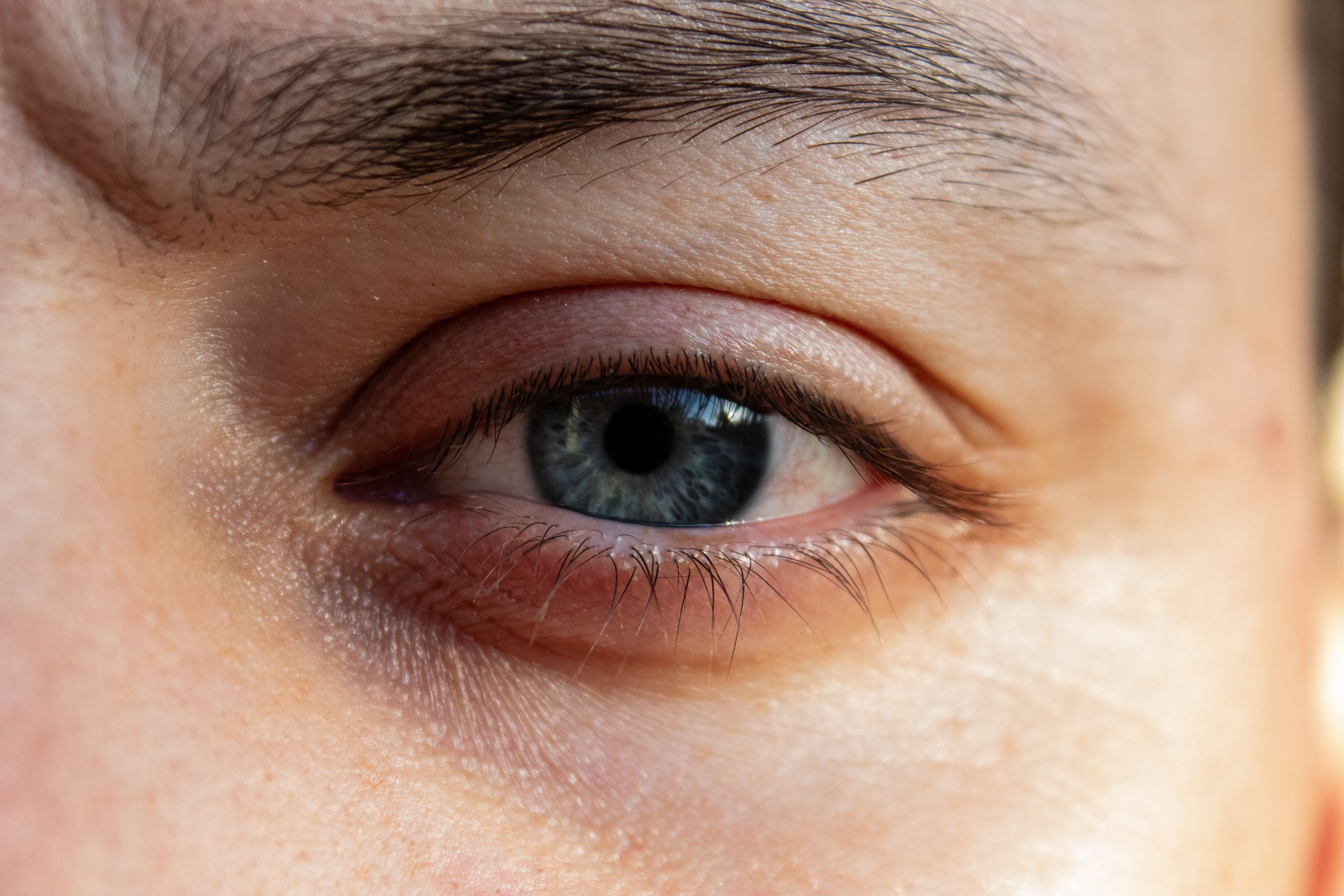 Seoul Eyelid Surgery & Recovery Journey – 8 Days view 1