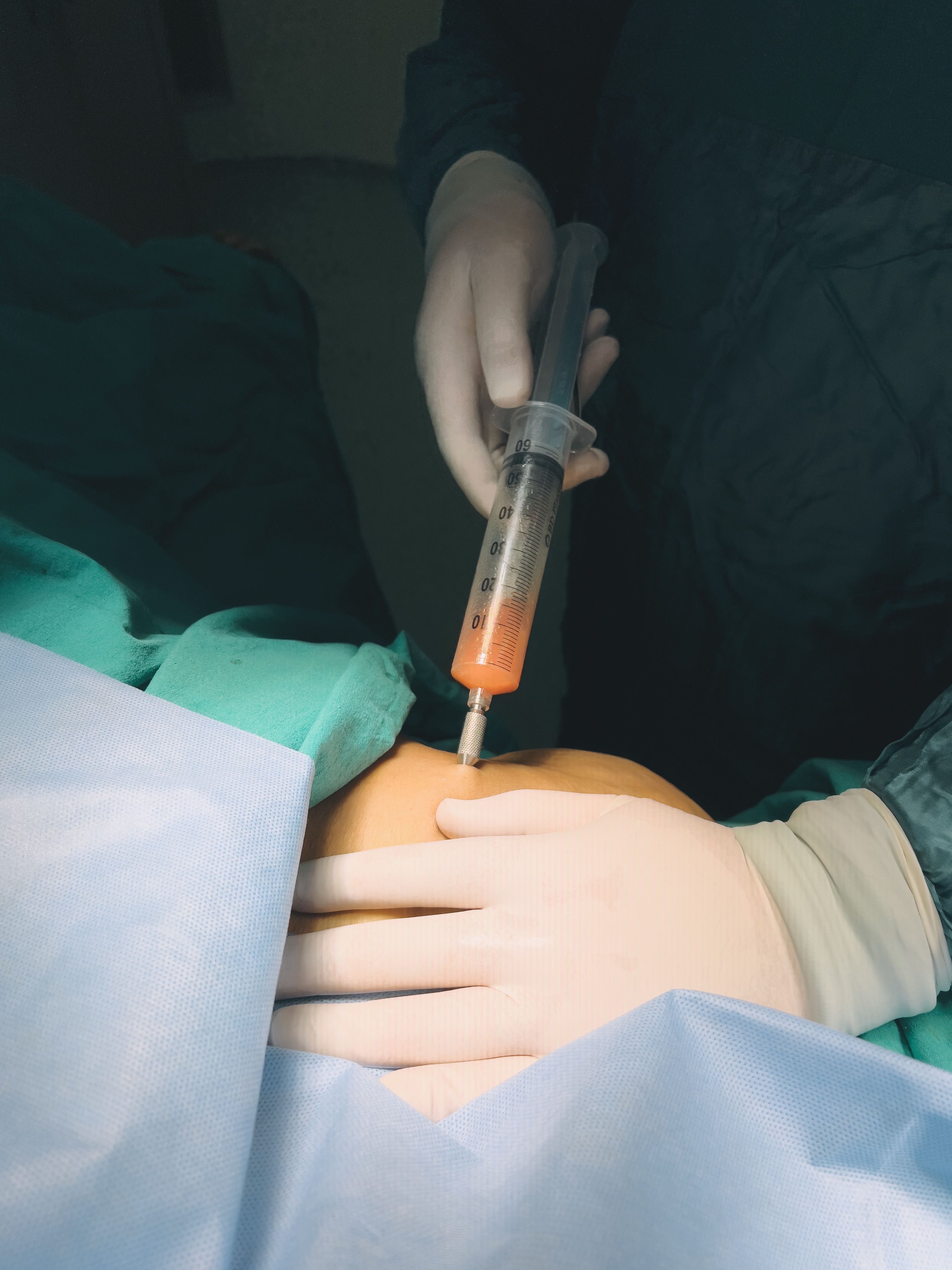 Seoul Body Liposuction & Contouring Recovery Journey – 8 Days — image 1
