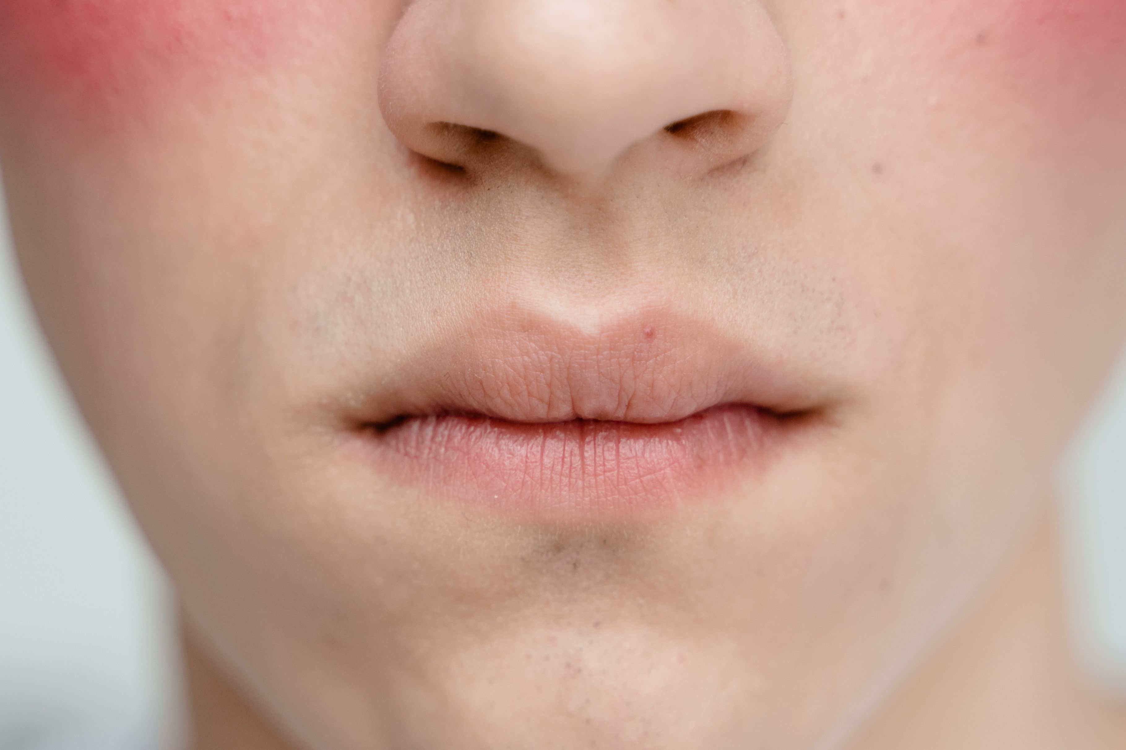 Seoul Redness, Rosacea & Sensitive Skin Care Journey – 3 Days — image 1